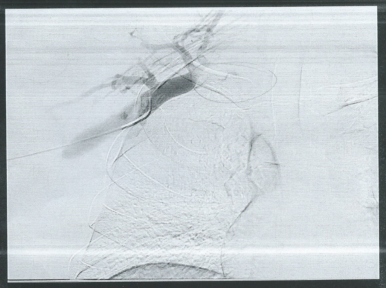 An anterior view ultrasound of the author's right shoulder before a venogram, showing blood obstructed in the subclavian vein. The dark areas indicate blood vessels where blood is stagnant.